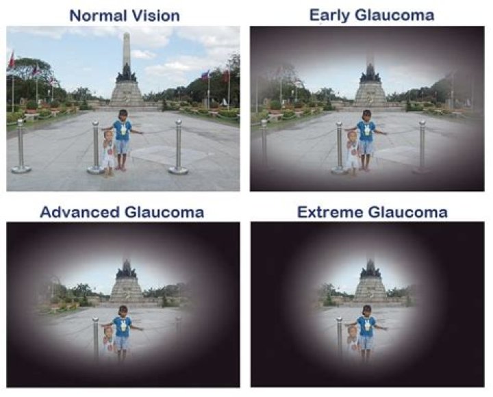 What vision looks like with glaucoma