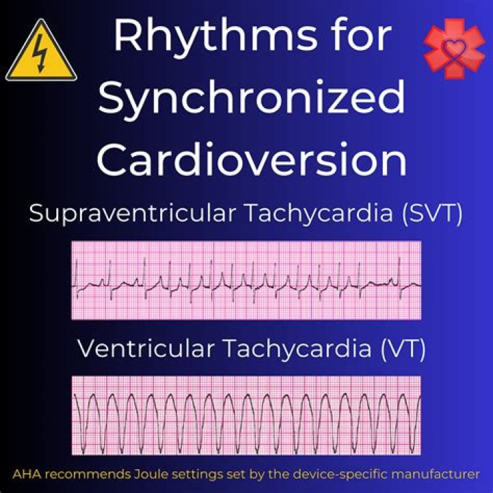 When should you do cardioversion
