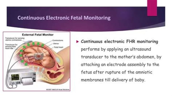 Where do you put an external fetal monitor