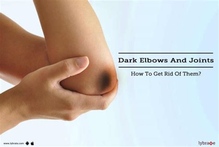 Why do I have dry elbows