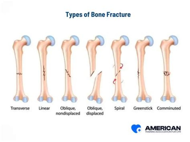 Why is it important to immobilize a fractured bone