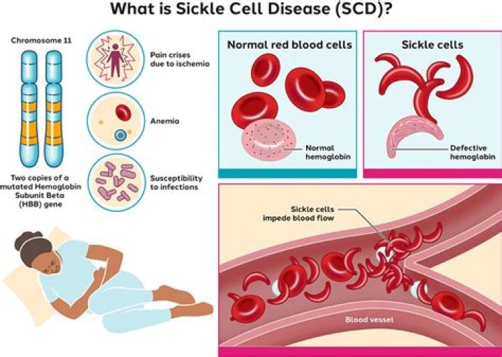 Why is sickle cell anemia codominant